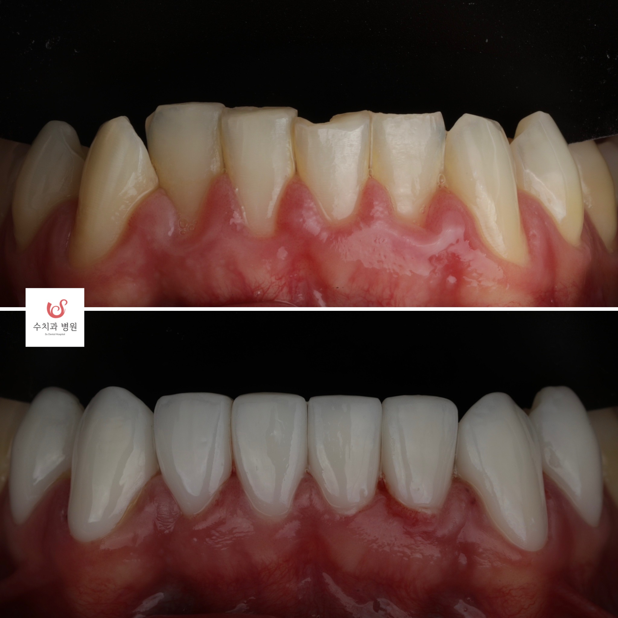 One-day veneer transformation — lower arch makeover