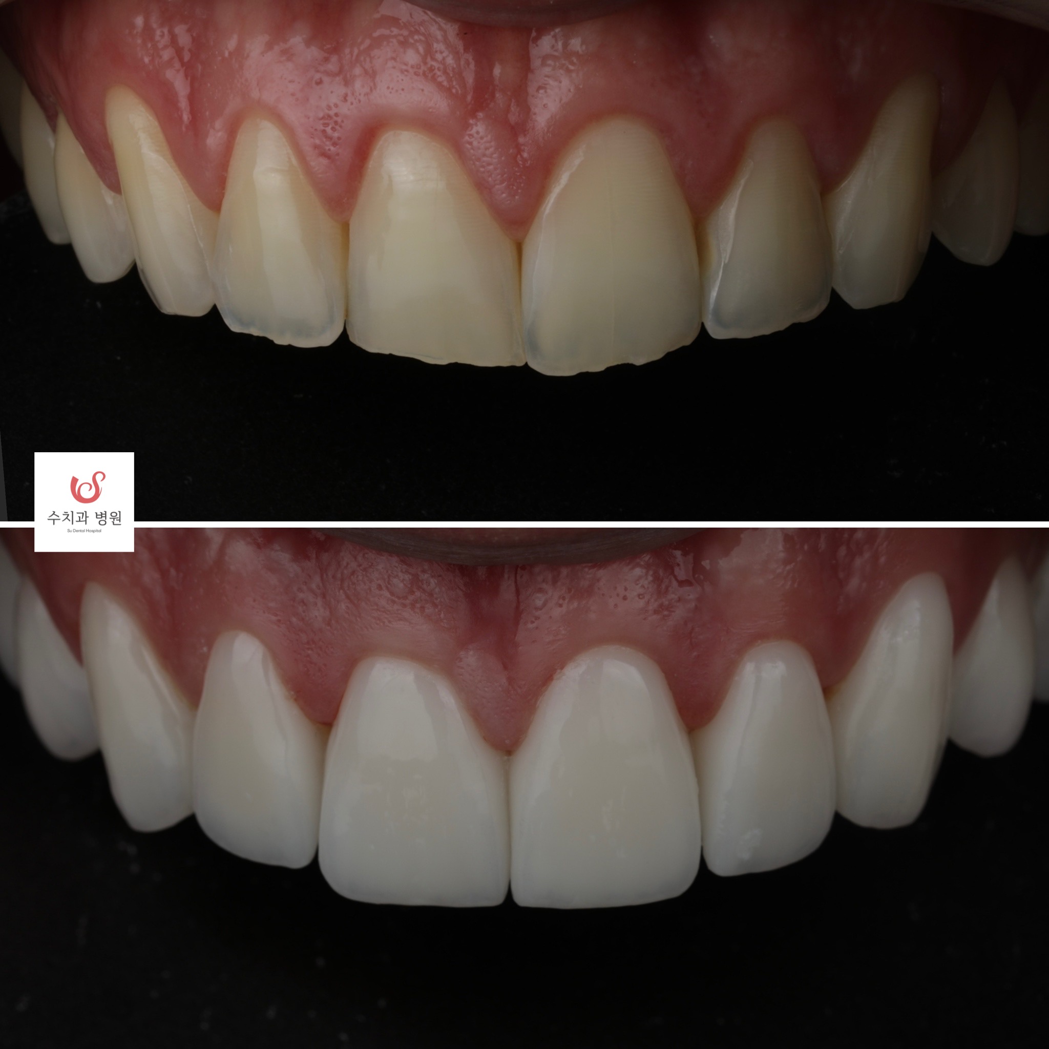 One-day veneer transformation — translucent edge correction