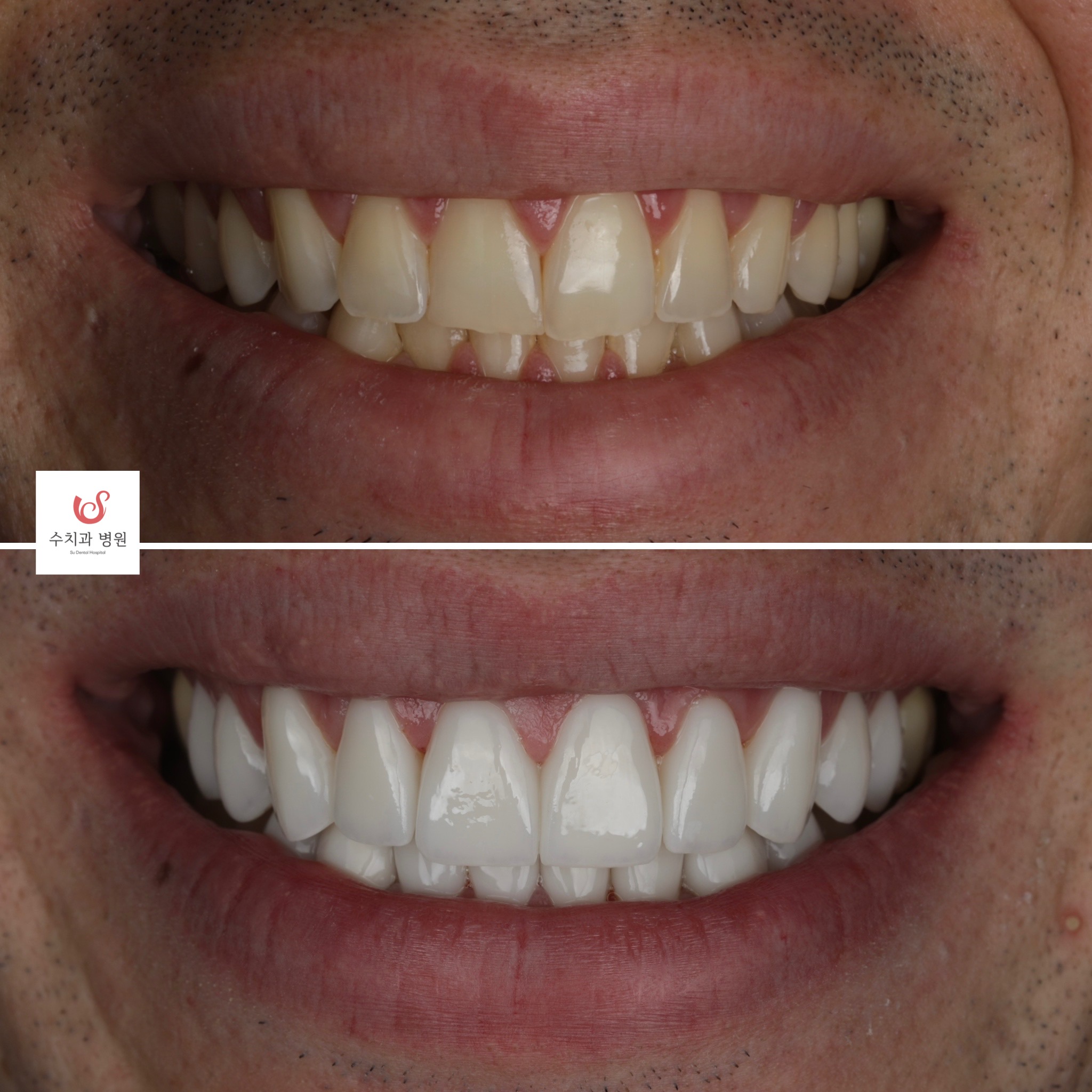 One-day veneer transformation — full smile reset