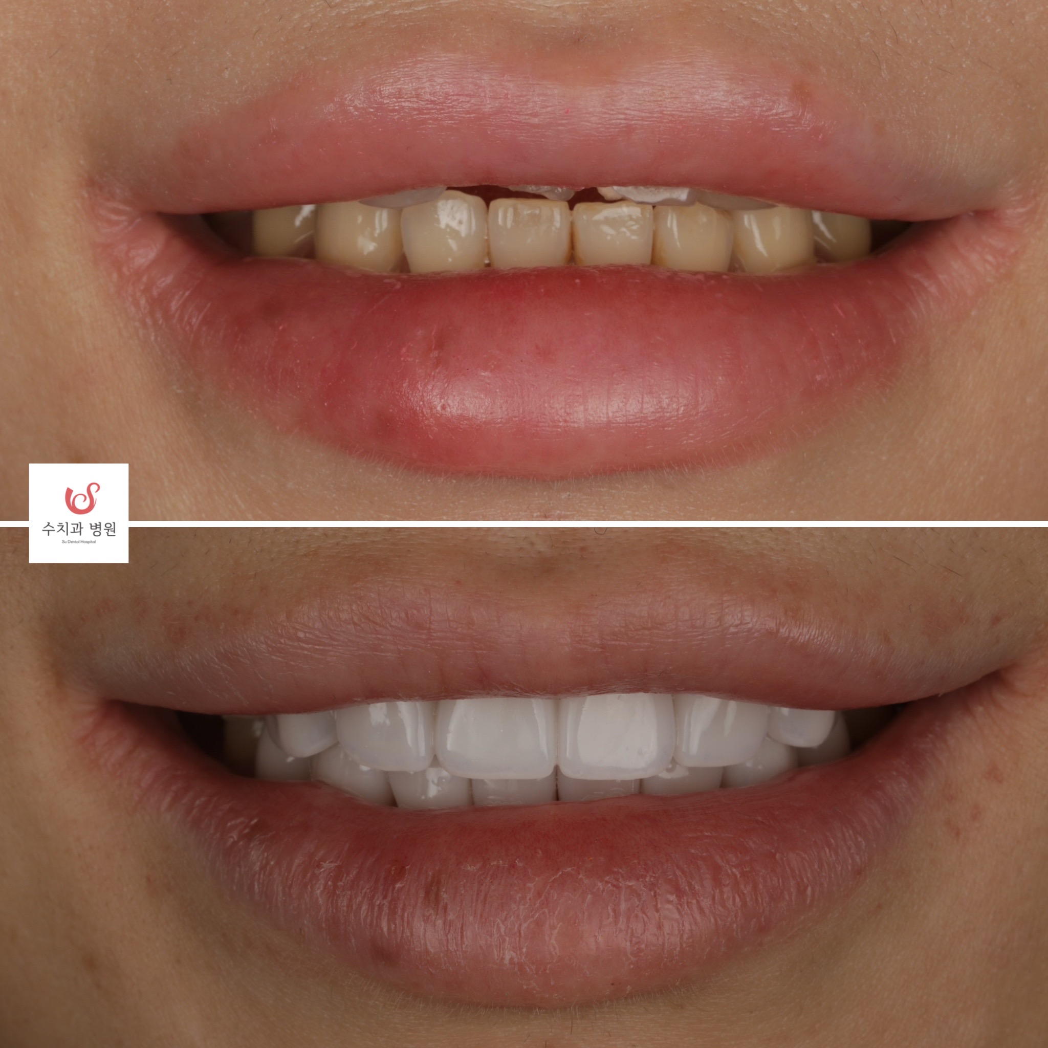 One-day veneer transformation — crowded teeth made uniform