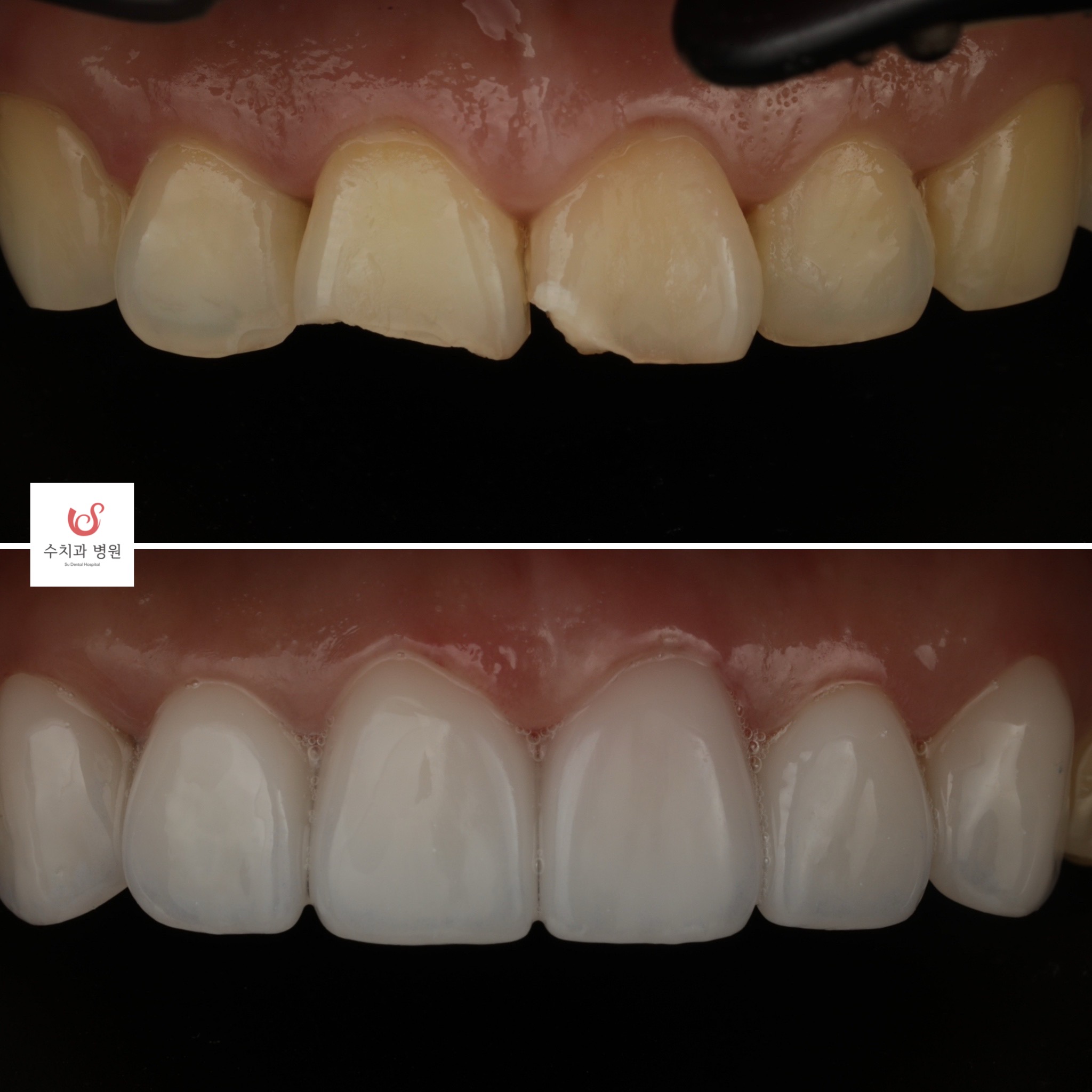One-day veneer transformation — chipped front teeth restored