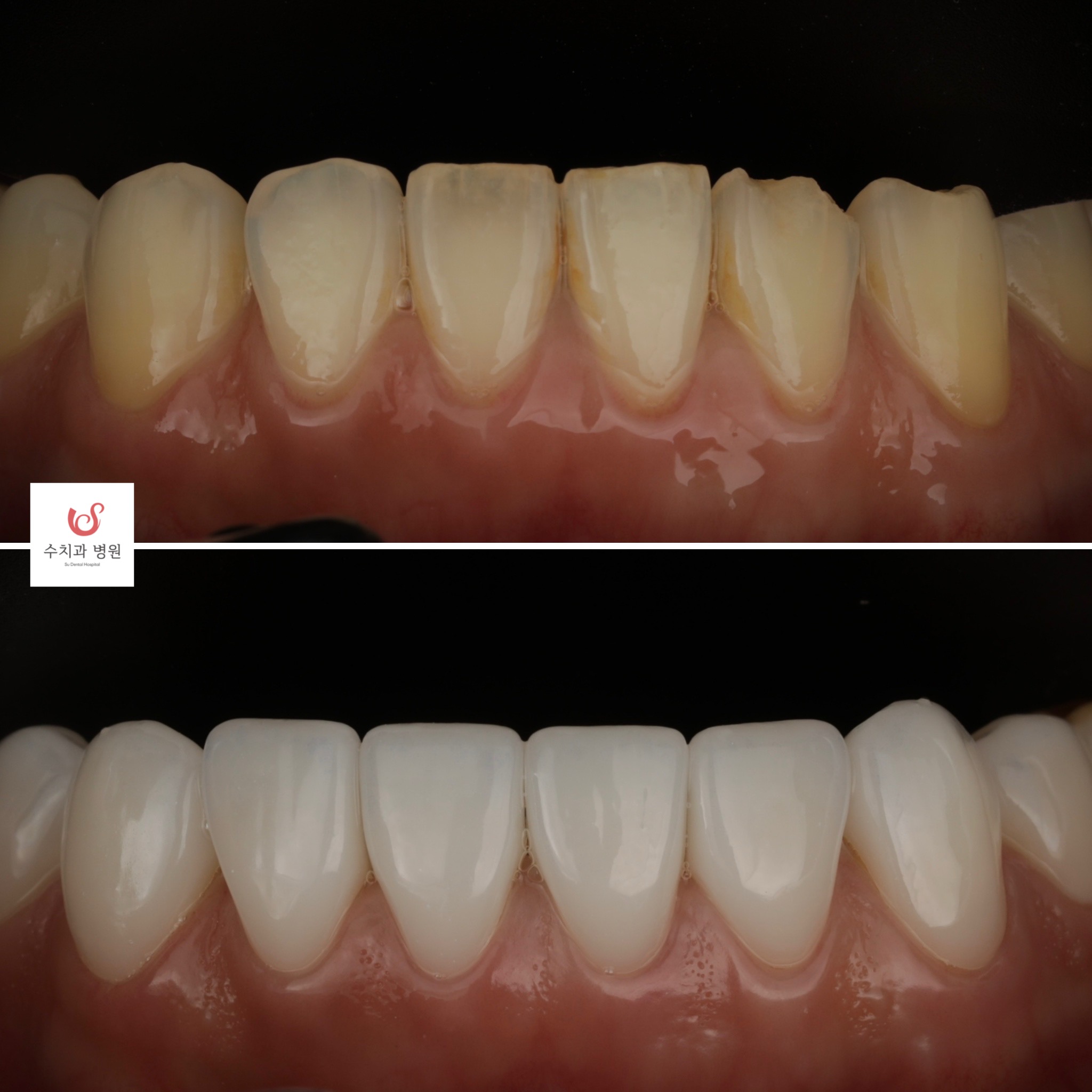 One-day veneer transformation — colour and contour