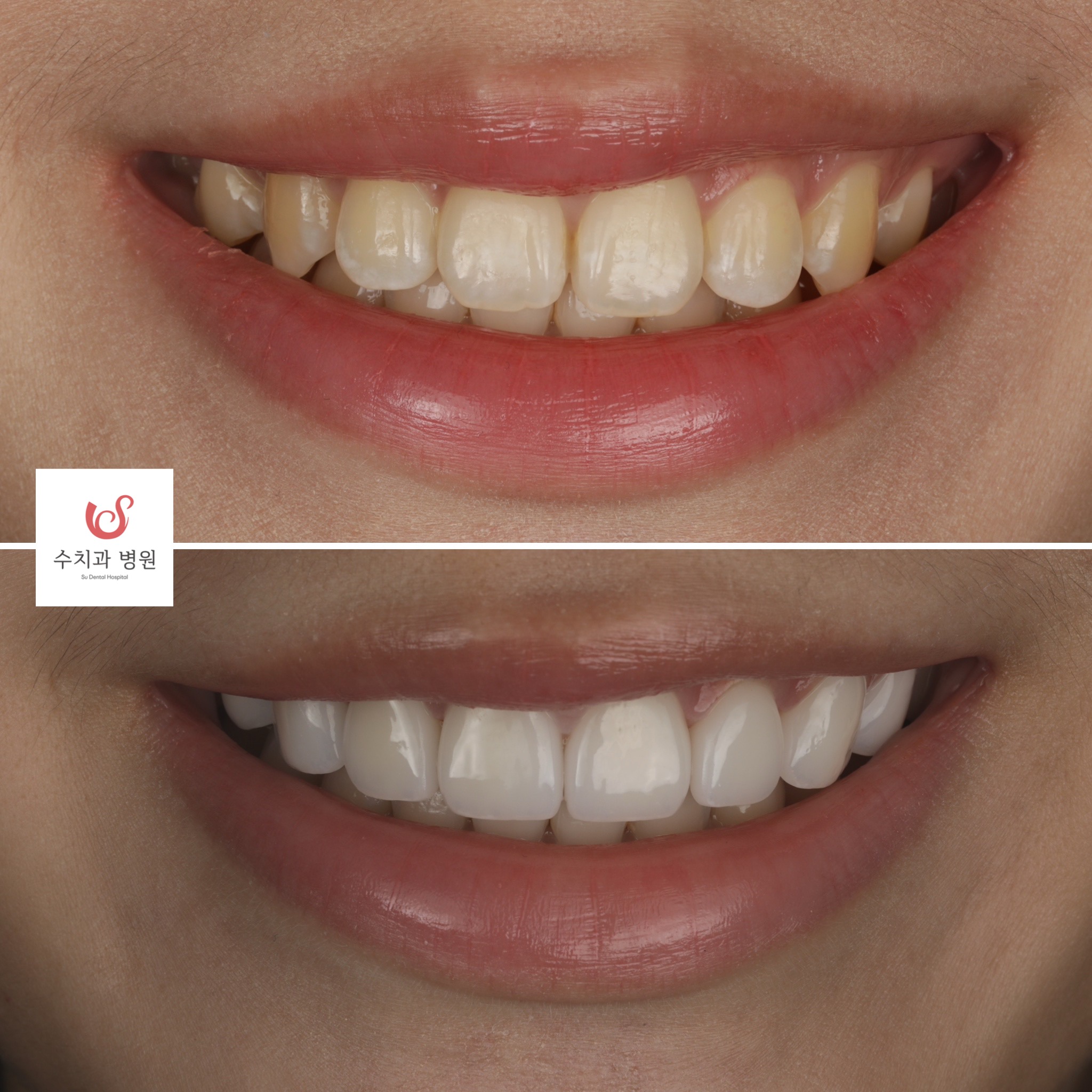 One-day veneer transformation — gummy smile refinement