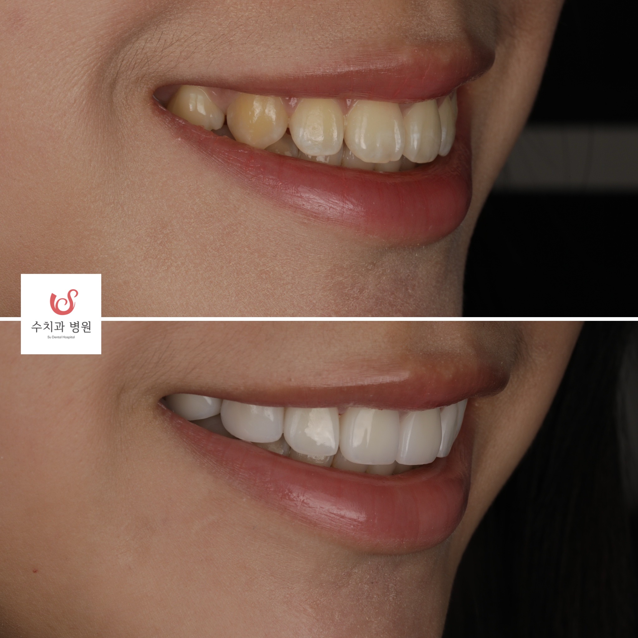 One-day veneer transformation — profile smile renewal
