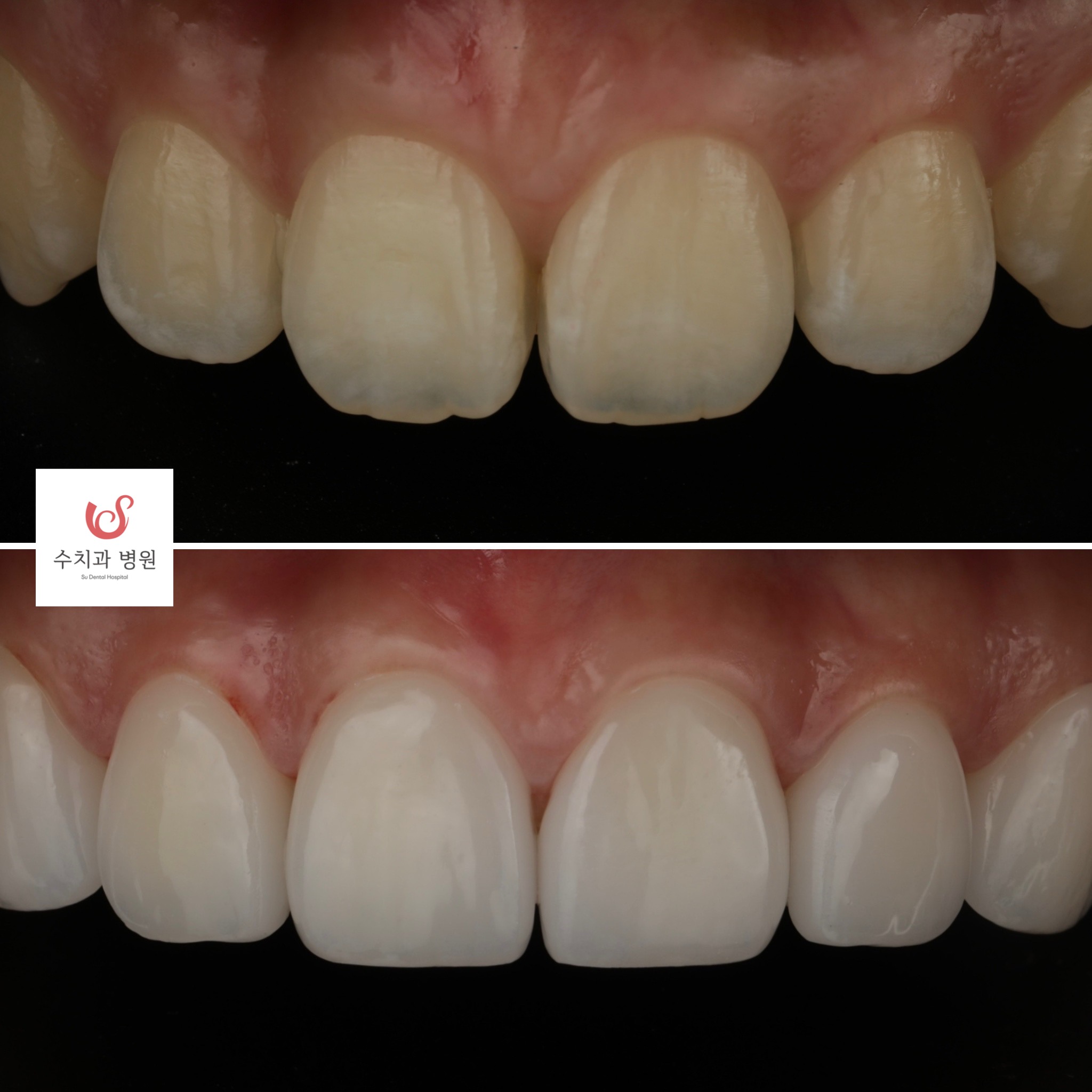One-day veneer transformation — diastema closure